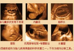 怀孕多久检查胎儿畸形（怀孕多久检查胎儿畸形最准确）