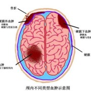胎儿颅内出血原因（胎儿颅内出血原因有哪些）