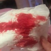 孕期出血鲜红（怀孕初期流黑红色的血是怎么回事）
