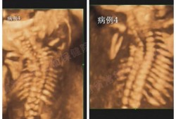 胎儿劲椎（胎儿劲椎有问题）