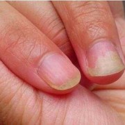 指甲空的厉害,孕期指甲空了一半不连着肉