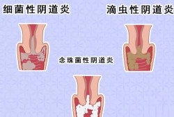 阴道炎影响胎儿吗