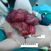 胎儿腹裂是怎么引起的（胎儿腹裂是怎么引起的原因）