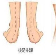 胎儿双足内翻怎么办（胎儿足内翻是脑瘫吗）