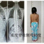 脊柱畸形胎儿（胎儿，脊柱曲度过大怎么办）