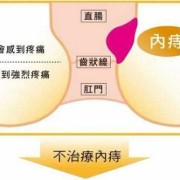 孕妇得痔疮了怎么办,内痔和外痔的区别图片