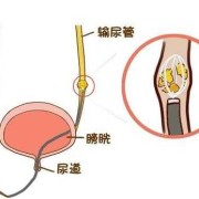 孕期尿路结石（孕期尿路结石怎么办）