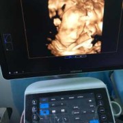孕妇二维彩超检查什么啊？不知道一般情况下检查哪些方面,孕期彩超做的频繁对胎儿有影响吗