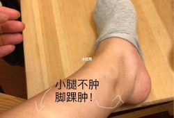 减轻孕期水肿（孕妇脚水肿怎么办）