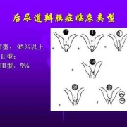 胎儿后尿道瓣膜（胎儿后尿道瓣膜）