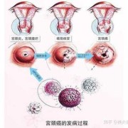 孕期宫颈疼（宫颈口痛是怎么回事）