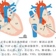 胎儿右心室强光斑原因（左室强光点是什么原因）