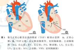 胎儿右心室强光斑原因（左室强光点是什么原因）