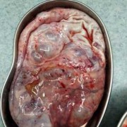胎儿盆腔囊肿（胎儿盆腔囊肿）