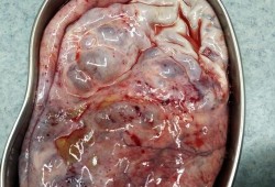 胎儿盆腔囊肿（胎儿盆腔囊肿）