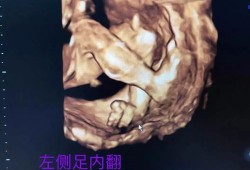 四维查出宝宝心脏畸形怎么办才好的呢,胎儿心脏外翻超声表现
