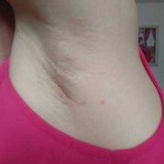 孕期腋窝下有肉疙瘩（孕期腋窝下有肉疙瘩怎么回事）