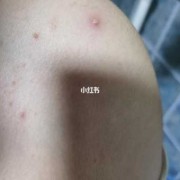 怀孕长痘痘怎么回事,怀孕期间长痘痘是什么原因