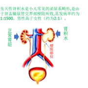 胎儿输尿管狭窄怎么办（输尿管狭窄导致肾积水的治疗方法）