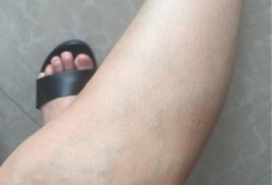 孕期腿肚酸（孕期腿肚酸）