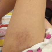 孕期腿上长了小红疙瘩（孕妇腿上长妊娠纹怎么去除）