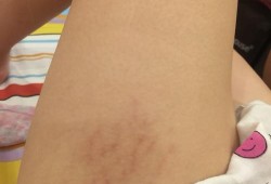 孕期腿上长了小红疙瘩（孕妇腿上长妊娠纹怎么去除）