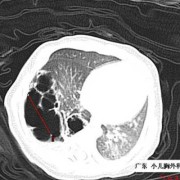 胎儿右肺囊腺瘤（先天性肺囊腺瘤会变小吗）