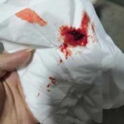 尿路感染有血很严重吗，尿路感染出血怎么回事,孕期尿路感染出血对胎儿有影响吗