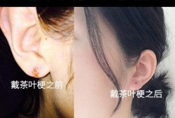 粘连带会在孕期撑开吗（耳环戴不进耳洞怎么办）