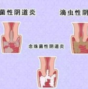 霉菌阴炎对胎儿的影响,