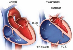 胎儿心脏三尖瓣少量返流，严重吗,胎儿三尖瓣中度返流会自行修复吗