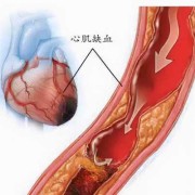 心肌缺血是什么意思,孕期心肌缺血对孩子有影响吗