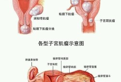子宫肌瘤影响胎儿发育吗（子宫肌瘤能生孩子吗）