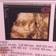 四维彩超能不能看出胎儿脸上是否有胎记,四维能看出胎儿胎记吗图片