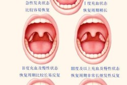 孕妇扁桃体发炎对胎儿（孕妇扁桃体发炎对胎儿有影响吗）