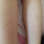 孕期小腿发红（孕期小腿发红不痛不痒）