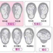 胎儿右枕前位是什么意思（胎儿右枕前位图片示意图）