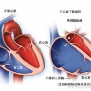 胎儿左右心室较不对称，怎么回事,胎儿右心室发育不良并三尖瓣狭窄