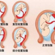 胎盘前壁胎儿图（胎盘前壁胎儿图片欣赏）