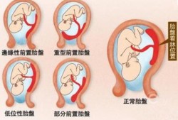 胎盘前壁胎儿图（胎盘前壁胎儿图片欣赏）