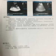 胎儿肾积水20mm严重吗（胎儿肾积水20mm严重吗怎么治疗）