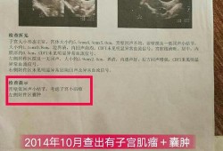 卵巢囊肿对胎儿有影响吗（怀孕了有卵巢囊肿对胎儿有影响吗）