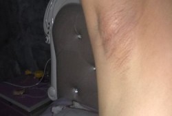 【 腋窝下有肿块如何消除】,怀孕期间液下有硬块怎么回事