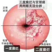 怀孕期间宫颈糜烂（中度宫糜烂对胎儿有应响）