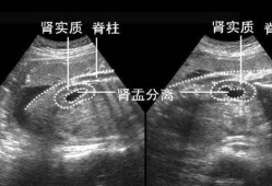 胎儿双肾盂轻度分离是什么意思,b超胎儿右肾盂分离是什么意思