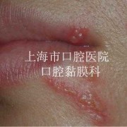 唇疱疹的发病原因,孕期唇疱疹会影响胎儿吗