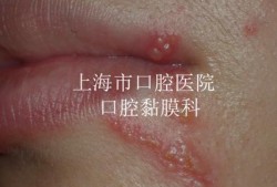 唇疱疹的发病原因,孕期唇疱疹会影响胎儿吗