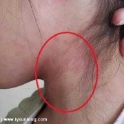 淋巴结肿大是怎么回事，淋巴结肿大的原因有哪些,怀孕期间淋巴结肿大怎么办