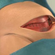 刨腹胎儿（剖腹产算生孩子吗）