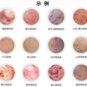 孕妇乳头出血是怎能么回事,孕期乳头出血原因有哪些